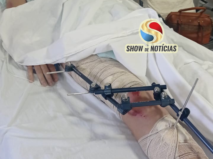 Motociclista que atropelou cachorro solto na rua e sofreu 09 fraturas no joelho e 01 na mo, aguarda regulao para cirurgia