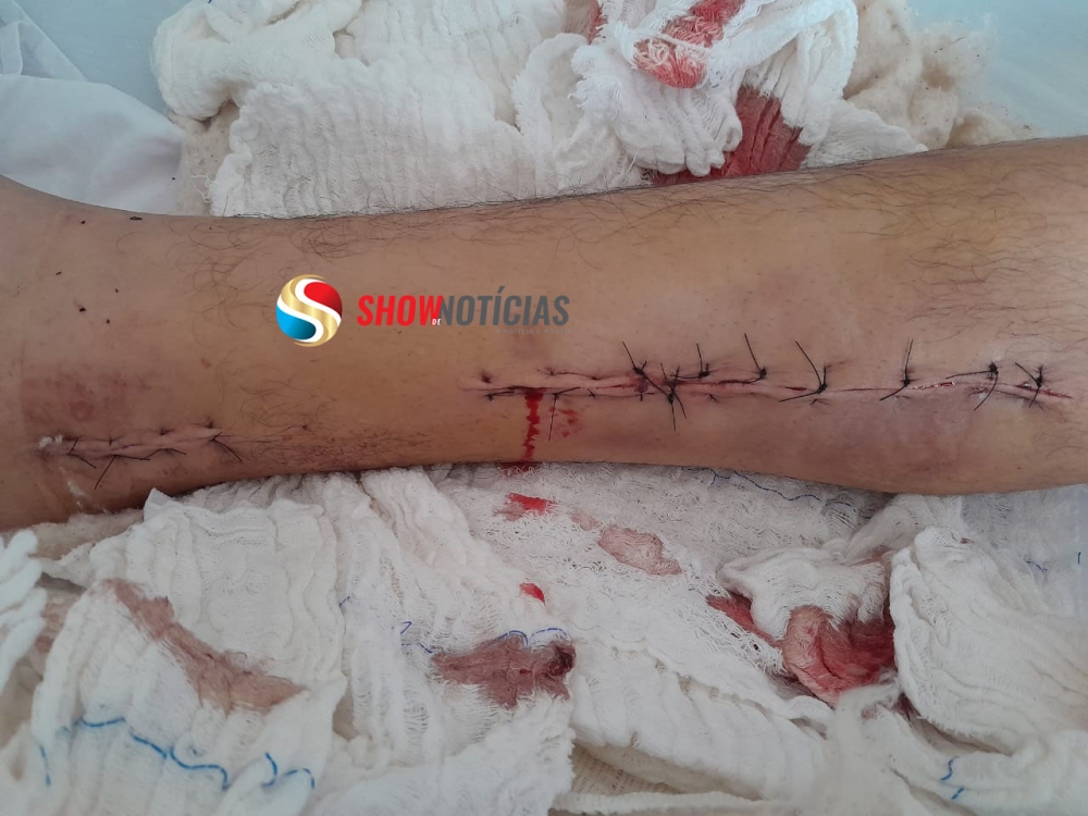 Jovem alvejado por tiro disparado por arma de PM em Juara foi submetido a cirurgia em Sinop e passa bem