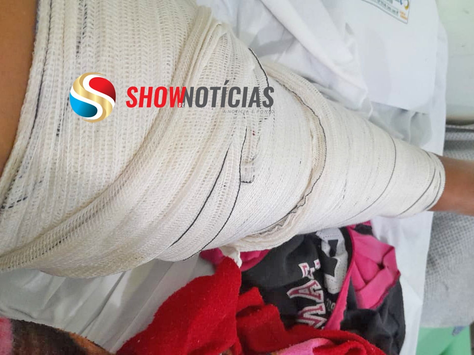 Mulher que quebrou a perna em acidente de moto em Juara, ser operada hoje, dia 30, em Vrzea Grande.